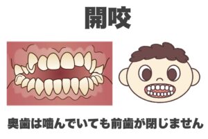 子どもの歯並びの種類　