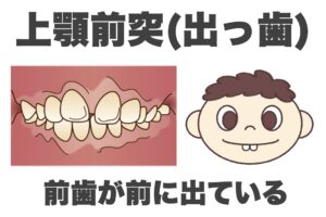 子どもの歯並びの種類